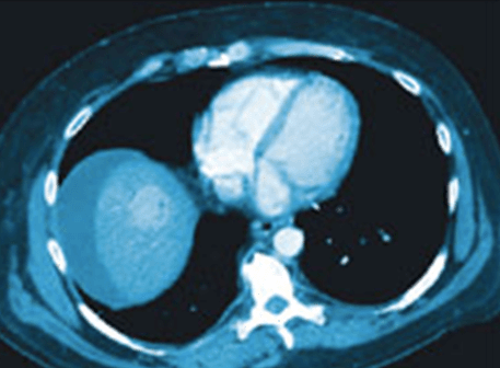 xray of a tumor